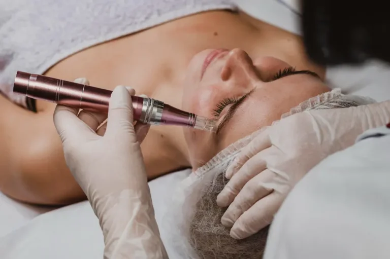 Microneedling Facial En Madrid