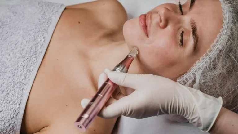 Microneedling Facial En Madrid